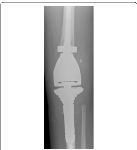 Fig. 5 Post-resection AP plain radiograph demonstrates a Stanmore prosthesis with integral distal femur and modular proximal tibial component