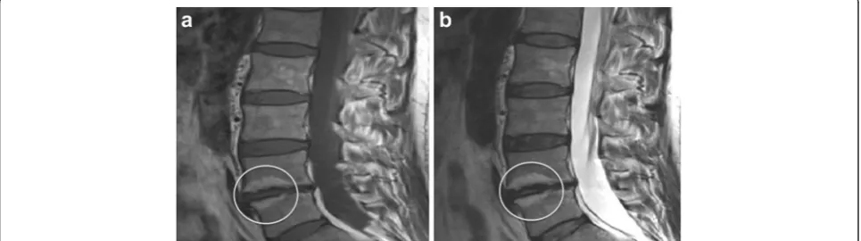 Fig. 1 An example of Modic type 2 change in the vertebrae adjacent to the L4/5 intervertebral disc, which also demonstrates reduced discheight