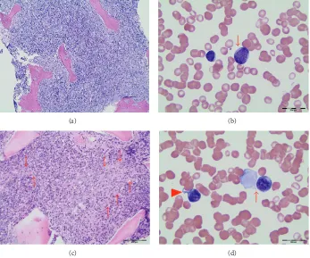 Figure 1: (a) Bone marrow core biopsy showing high cellularity with marrow space occupied mainly by early myeloid cells