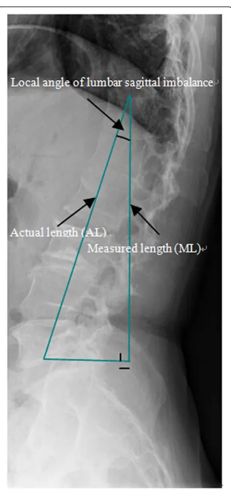 Fig. 1 The scoliosis width (W) was defined as the lineardisplacement distance between the boundary lines of the scoliosis