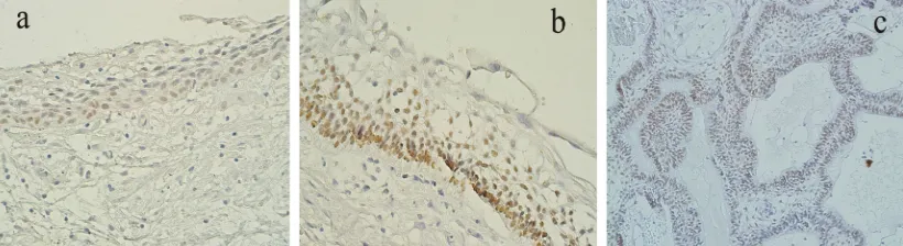 Figure 1a: toma. Intense immunostaining in lower layers ( P63 expression in dentigerous cyst in only basal layer