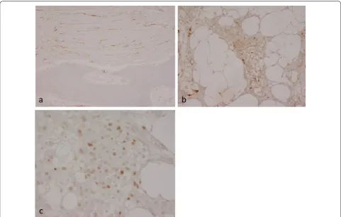 Fig. 5 Immunohistochemistry of PIM showing lesional cell expression of a EMA in fibrotic areas and b EMA and c PR in meningotheliomatous areas