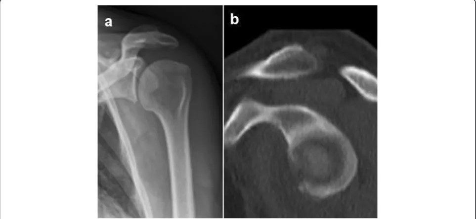 Figure 4 Case example of a large glenoid rim fracture and screw fixation.(a)screw fixation has been performed 69 year old female with traumatic anterior shoulder dislocation