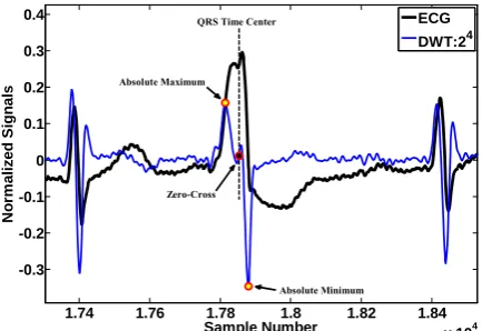 Fig. 7 Determination of the time center of a detected QRS complex using excerpted DWT scale 24
