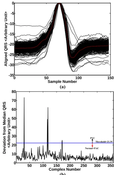 Fig. 8 (a) Time-Value aligned QRS complexes (black) and median QRS waveshape (red), (b) A sample error signal as a tool for PVC classification and the corresponding threshold