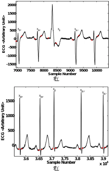Fig. 5 A delineated ECG trend [63] including normal node reset (Rcomplexes and (a) a PVC with a retrograde conduction into atrium (Rk Rk+1 > Rk-2 Rk-1) and (b) a PAC with delayed sinus k Rk+1 > Rk-2 Rk-1)