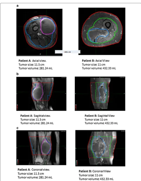 Fig. 3 a Patient A and B’s Tumor size and corresponding volume on axial view. b Patient A and B’s tumor size and corresponding volume on sagittal view