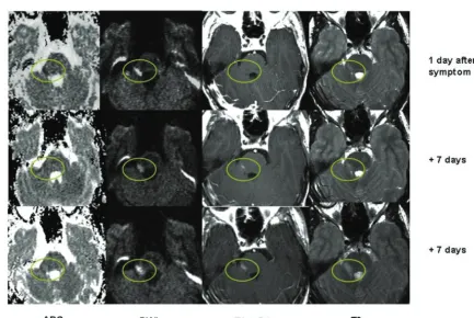 Fig 2. Exemplary ADC, contrast-enhanced T1-weighted, DWI, and FLAIR images of the first 4 MRI time points of patient 4 during the first 14 days after new symptom onset