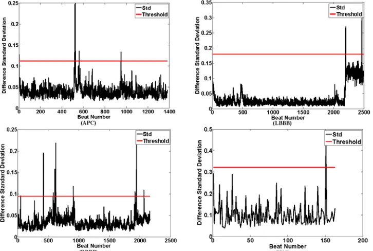 Fig. 3.  Cumulated beats and calculated mean template waveform for arbitrary records of the MITDB including APB, LBBB, PVC and RBBB classes