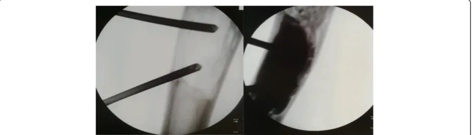 Fig. 1 Two needles technique. Transcortical administration of the flowable bone substitute by the use of one injection needle and one“ventilation” needle