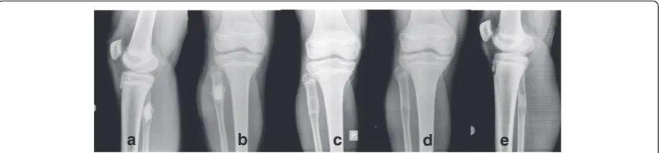 Fig. 3 Full remodeling after 12 months. Patient treated with 15 mL of bone substitute