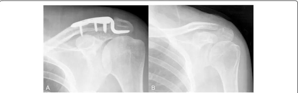 Fig. 3 AC joint dislocation treated by hook plate resulting in degenerative osteoarthritis.dislocation treated by hook plate