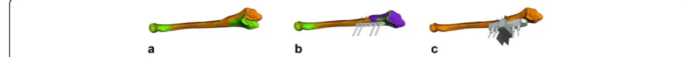 Fig. 1 Preoperative Plan. Outline of the investigated computer-assisted planning approach.the proximal part of the pathological bone (orange) with the mirrored contralateral bone (green)