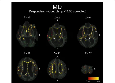 Fig. 4 White matter regions in which MD values were significantly higher in shunt-responsive INPH