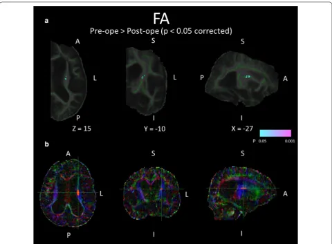 Fig. 5 White matter regions in which FA values significantly changed after shunt placement