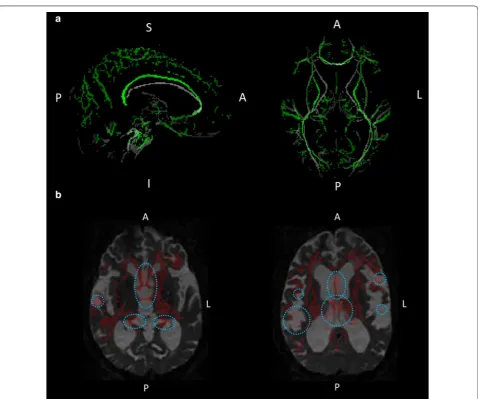 Fig. 1 Comparison of skeletons and mis-registrations observed in TBSS analysis. a Demonstrates the mean FA skeleton (green) derived from the study (the comparison between the patients with INPH and the healthy control subjects) and the FMRIB58 FA standard 