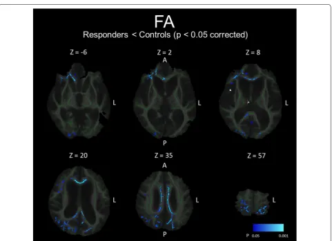 Fig. 2 Changes in left VV/ICV ratio, hemispheric FA, and hemispheric MD after shunt placement