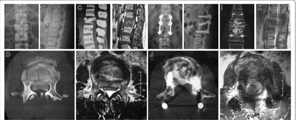 Figure 5 Follow-up images (case 18).radiograph showing a correct position of two cages placed to intervertebral space and the posterior transpedicular system