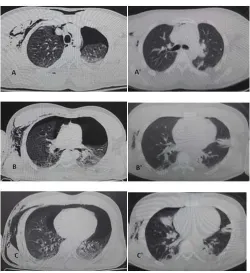 Figure 2 Portable antero-posterior chest radiograph images of the patient's tubes and high-flow oxygen therapy, note the corresponding left basal opacity anterior, in image 2 the patient is observed after the placement of endopleural evolution, in image 1 