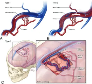 Fig 2. Schematic overview of the Borden system of classifi-lesions are associated with cortical venous reflux
