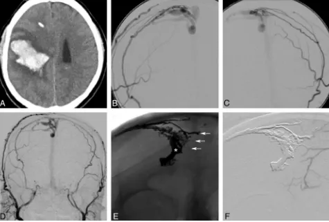 Fig 3. A 52-year-old man presented with severe headache, slurred speech, and acute left hemiparesis.DAVF (Borden type 3) with arterial supply from the bilateral middle meningeal and superficial temporal arteries