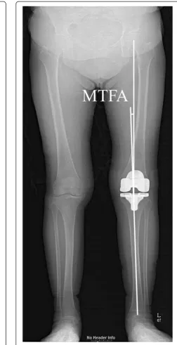 Fig. 1 The anatomic tibiofemoral angle (ATFA) was measured as asurrogate of anatomic limb alignment