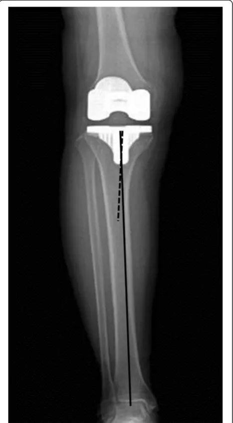 Table 5 Sensitivity of three commonly used ranges foranatomic limb alignment in predicting knees with valgusmalalignment using the mechanical limb alignment method*