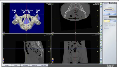 Fig. 2 Process of placing anterior pelvic plane and midsagittal plane in the virtualized pelvis using the landmarks superior iliac anterior spine [SIAS]and tuberculum pubicum of both sides