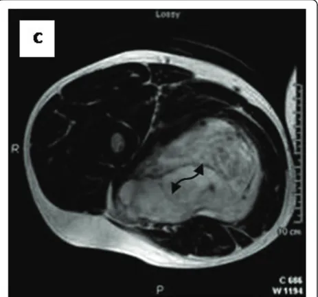 Figure 5 Axial T2WSE The mass contains ill-defined areas oflower intensity relative to subcutaneous fat on T2WSE.Internalseptations are evident (curved double arrow).