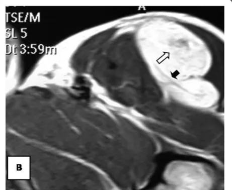 Figure 15 Axial T1WSE before injection at another level.