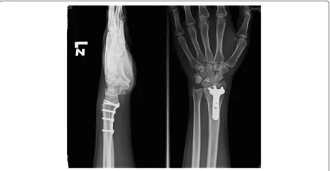 Figure 3 The Postoperative film shows good reduction of the fracture and position of the plate.