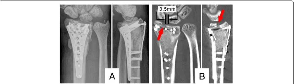 Figure 3 Postoperative computed tomography. A) Postoperative radiographs; B) postoperative computed tomography, the red arrows showa 2-3 mm intra articular gap and the scapholunate ligament dissociation of 3,5 mm is marked.