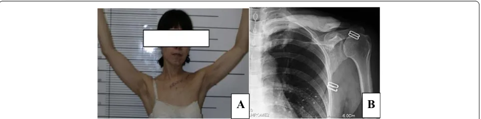 Figure 4 Shoulder outline and X-ray of postoperation. A: Post-operative shoulder outline and functional display