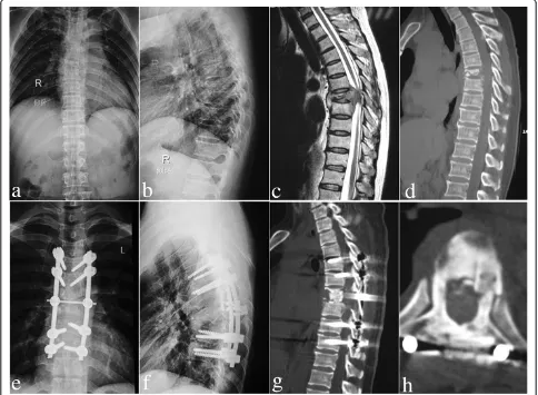 Fig. 3 A 52-year-old female with T5/6 lesions was performed by posterior-only approach.satisfied allograft fusion without relapse of Pott a-d The pre-operative imaging data showed T5/6vertebral bodies’ destructions with mild kyphosis deformity and spinal c