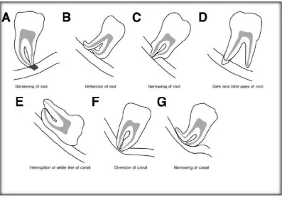 Figure 2: Rood’s Radiographic Predictors of Potential Tooth Proximity to the 