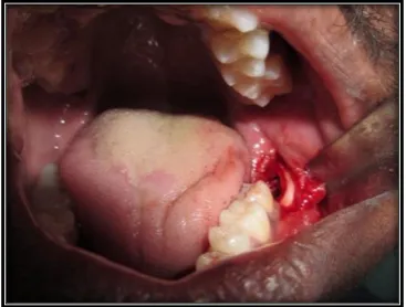 Figure 2: POST-EXTRACTION SOCKET 