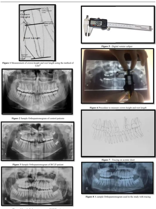 Figure 4 Sample Orthopantomogram of UCLP patientSample Orthopantomogram of UCLP patient 