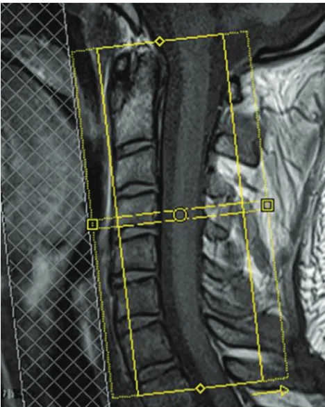 Fig 3. Axial FA color image of a control subject’s cervical spinal cord (left). Manual placement of region of interest (middle)