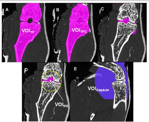 Figure 9 Result of vessel segmentation. (A) Volume growing based on local adaptive thresholds; (B) Multi-scale based segmentation method.
