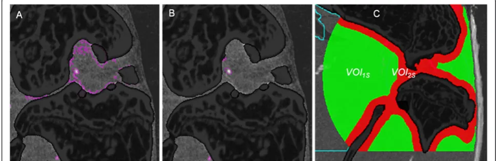Figure 7 Incorrect vessel classification. (A) Soft tissue classified as vessel close to the bone surface due to beam hardening effects using localadaptive threshold (LAT) segmentations