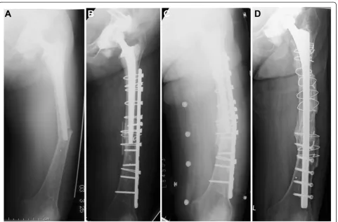Figure 2 Case 5, A seventy- years-old woman who sustained a Vancouver type-B1 periprosthetic femoral fracture seventy eight months afterplate.revision surgery using a long stem