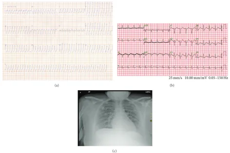 Figure 1: Electrocardiogram of a 25-year-old woman showing an episode of sustained ventricular tachycardia (SVT) with very fast heart rate(approximately 300 bpm) after scorpion envenomation (a)