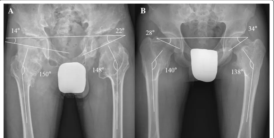 Figure 3 The initial visit of two patients with HME. (A) A 4-year-old boy in group 1 and (B) a 12-year-old boy in group 2.