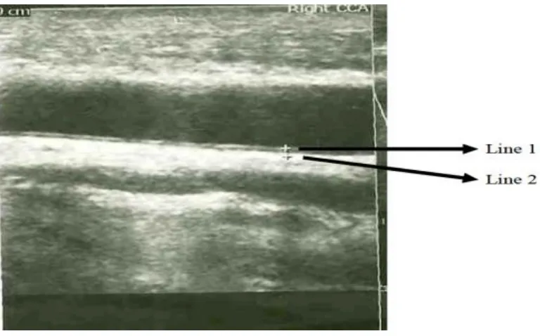 Figure 4: Showing USG guided measurement of  IMT in Common carotid artery 