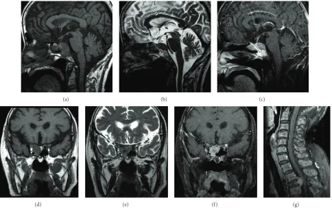 Figure 1: (a)–(f): Sagittal and coronal T1- ((a), (d)), T2- ((b), (e)), and Gd-enhanced T1-weighted ((c), (f)) MRI of the brain show a parasellarmass lesion
