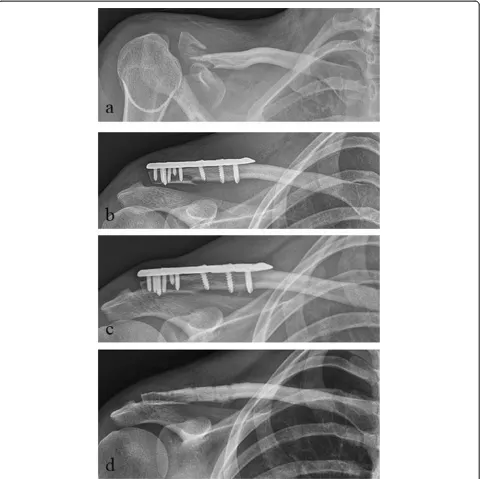 Figure 4 Radiological outcome of a lateral clavicle fracture J&B II b. a preoperative; b postoperative; c 1-year follow-up; d afterplate removal.