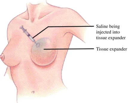 Fig. 1. Tissue expander technique. (From Wilkins E. The University of Michigan Breast Recon-struction Handbook