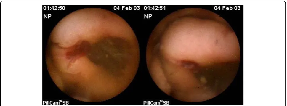 Figure 3 Images taken by CE of a 25 mm bleeding tumour in the jejunum.
