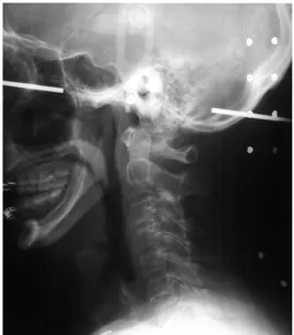 Figure 1. Example of a lateral radiograph in the neutral posture from Snyder et al. (1975)