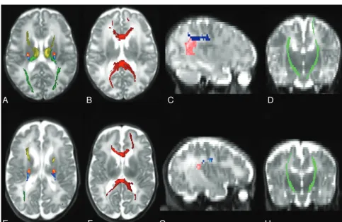 Table 1: WMA assessment at conventional MRI